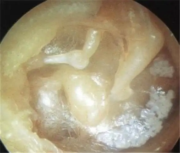中耳炎图片_中耳炎症状表现图片大全_有来医生