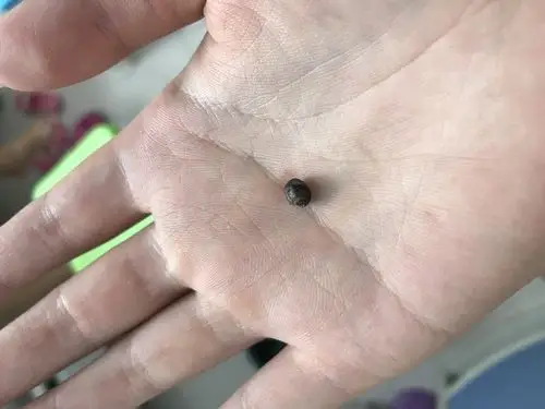 身体里长出黑色硬物?到底是什么?