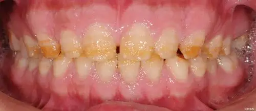 【病例讨论】一例少见的全牙列釉质发育不全患者,求修复方案 [病例帖]