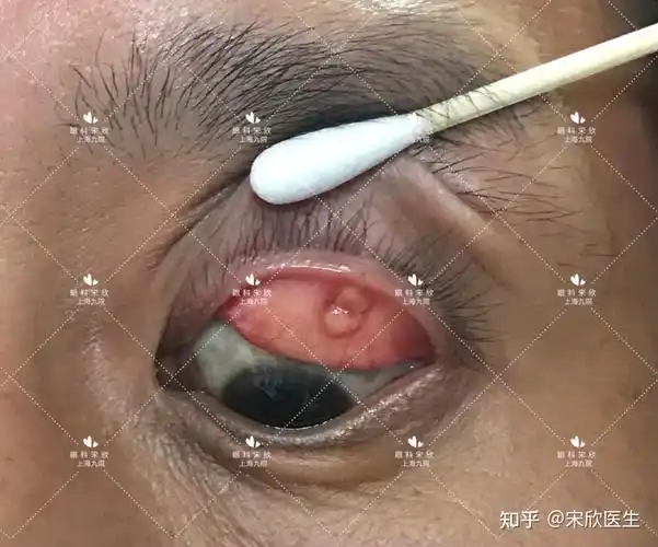 霰粒肿反反复复是何故警惕有可能是皮脂腺癌