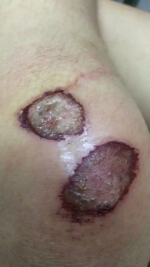 骑车摔了一跤膝盖擦伤,过了三天感觉有点结痂了就洗了个澡,结果化脓
