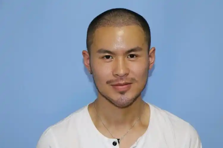 【种植胡须】【首瑞植发胡须种植 大额满减买送】华西青年名医 国家