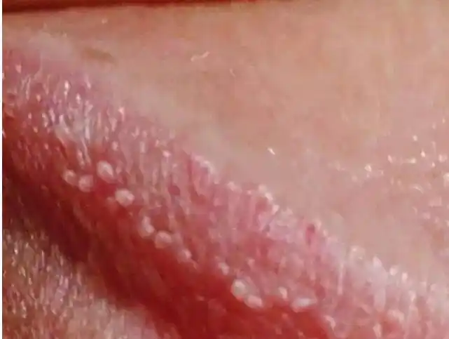 男性生殖器官长疙瘩是怎么回事