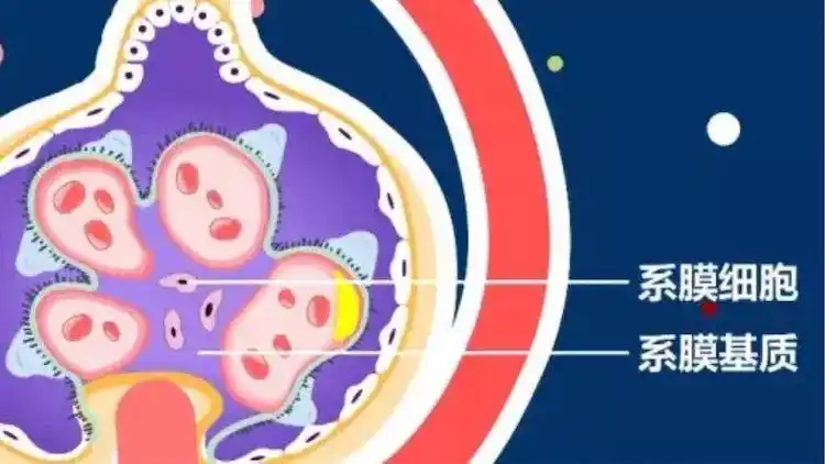 不断扩张地盘 从"基底膜"城墙逐渐扩张到寨子中心 "系膜细胞和基质"