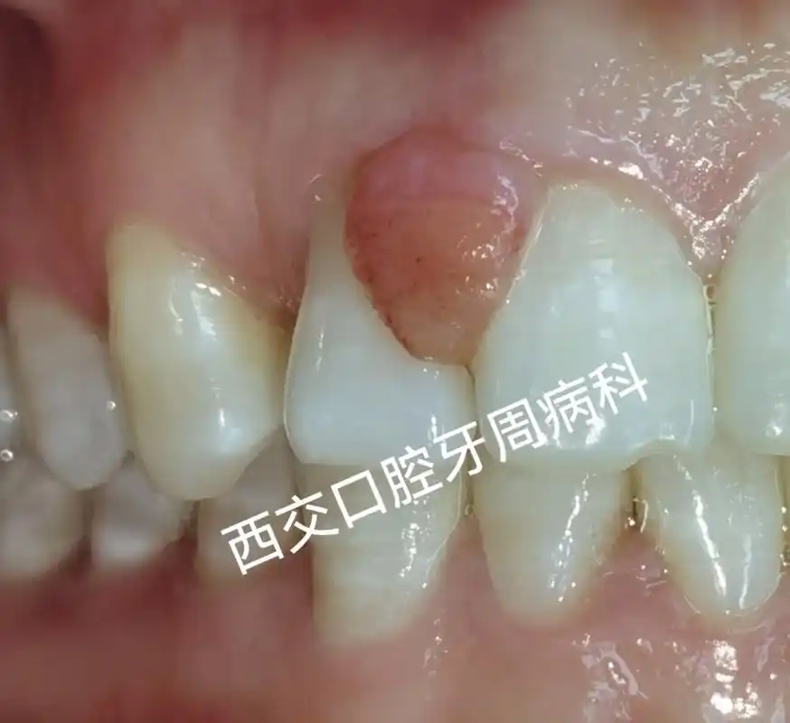 牙龈瘤,是牙龈上特别是龈乳头区局限生长的炎性反应性瘤样增生物