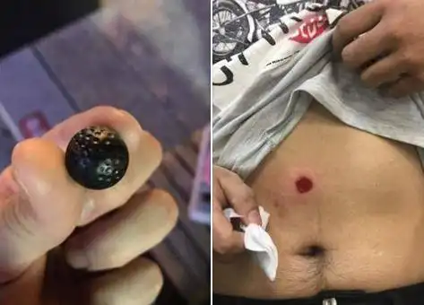 「开合跳」打招呼遭镇暴枪射击 腹部瘀青红红一块