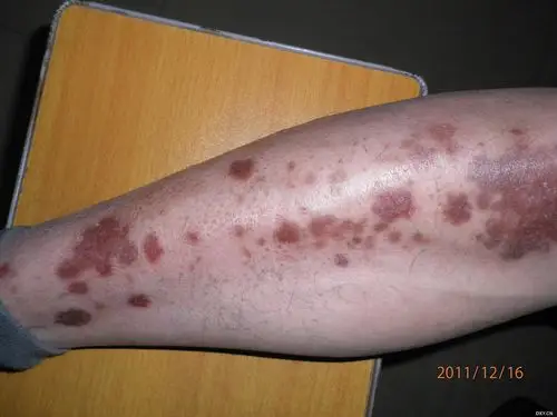 【病例讨论】双下肢红斑 - 皮肤与性传播疾病讨论版 -丁香园论坛