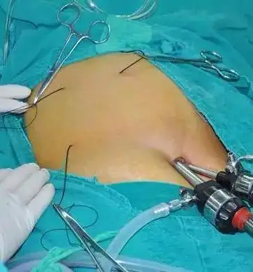 随着微创技术的不断发展和腹腔镜技术的成熟,外科医师开始尝试用更少