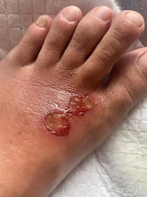 脚面烫伤恢复过程有同样类似经历的请进请指导