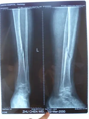 13岁男孩,骨折已4月 尚未愈合