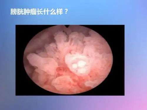 膀胱癌医学ppt课件pdf43页