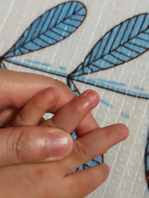 刚开始发现手指甲有小白点时去查的微量元素  轻微缺钙  缺锌   疑