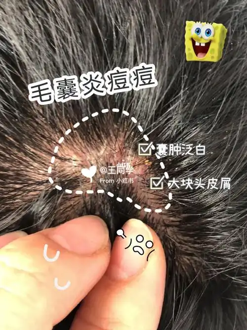 毛囊炎痘痘脱发熬夜党该拯救发际线啦