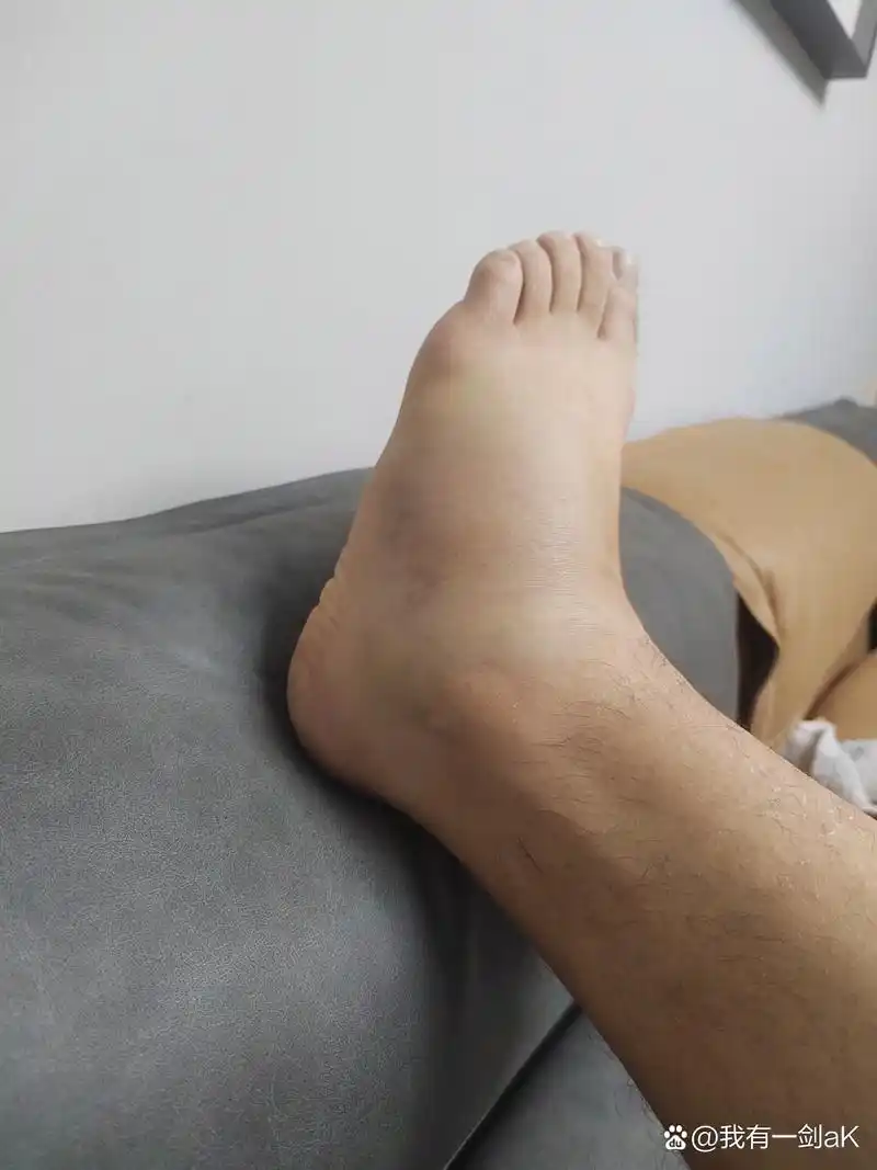 脚侧扭伤了,肿了不是很疼,但是下地走不了路,拍片没事,大家看看最快几