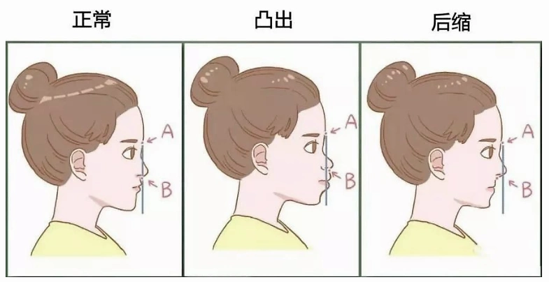 在廊坊,骨性龅牙做牙齿矫正有用吗?__凤凰网