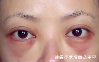 眼袋手术后凹凸不平.jpg