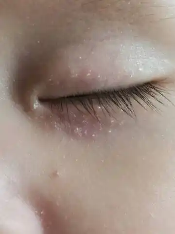 想请问下这个眼睛附近小颗粒,红色的有白点的刚昨天开始有,宝宝7个月