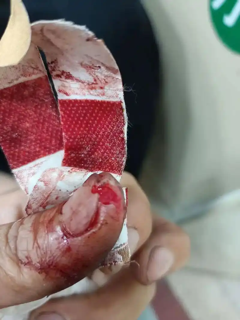 好朋友早几天不小心弄伤了手!