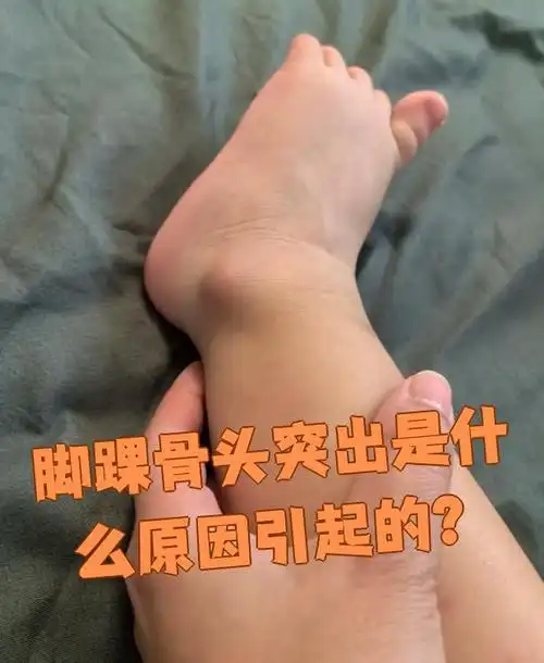 脚踝骨头突出是什么原因引起的?
