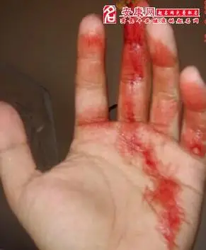 梦见手掌流血