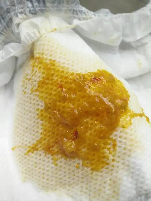 宝宝便便里有血丝.有图慎入