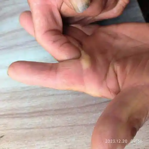 手部表皮样囊肿