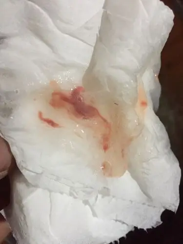 请问你们有过这种痰液嘛