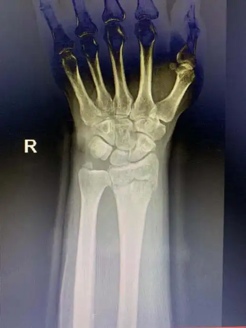 右侧桡骨远端骨折