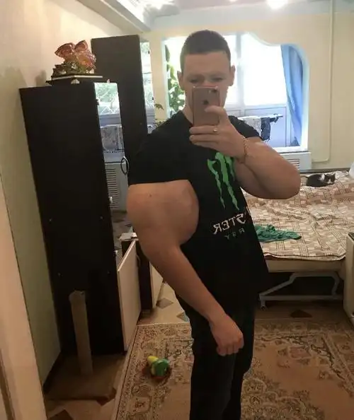 小哥往手臂注射药物成大臂哥,现在肌肉坏死要切了