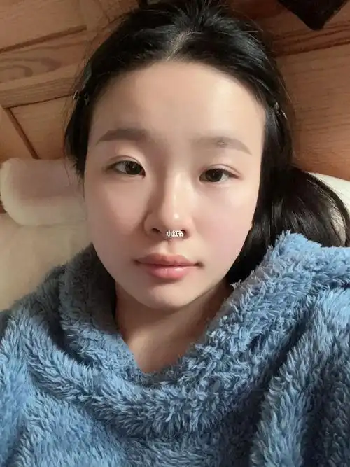 埋线双眼皮第七天,看着很自然越看越喜欢!#埋线双眼皮恢复