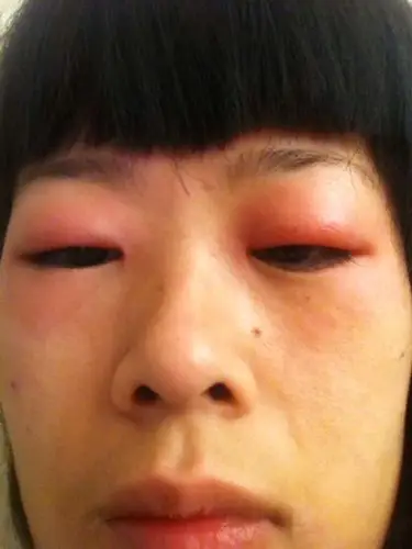 我是一个干夜场的人员,每天都得到凌晨3点才能睡,今天一觉醒来眼就肿