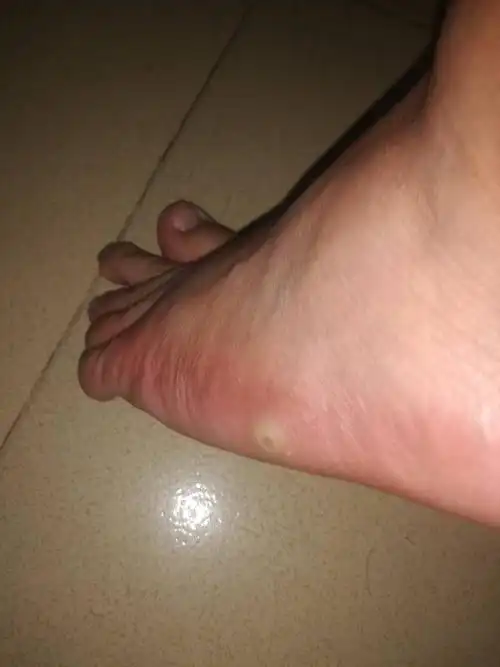 有谁知道,我脚上生的是啥?(就是那块白白圆圆那里的)