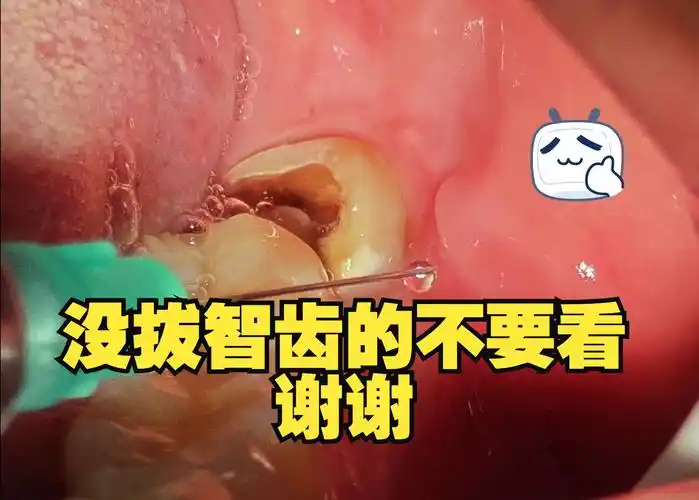 智齿拔除全过程,没拔智齿的别看,慎重