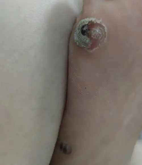 跖疣记录帖(有图慎入但是只有两个)