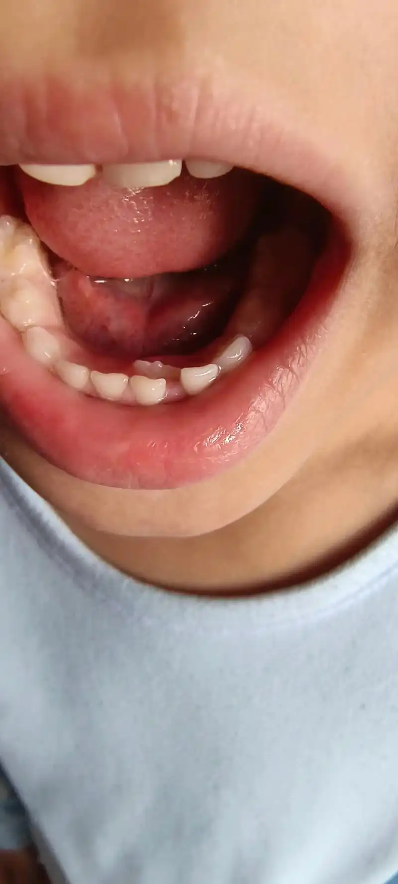 换牙期.小孩换乳牙的时候,如果乳牙还没掉就长出来新牙了,新牙 - 抖音