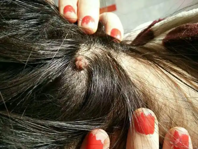 皮肤与性传播疾病讨论版 相关疾病: 皮脂腺痣