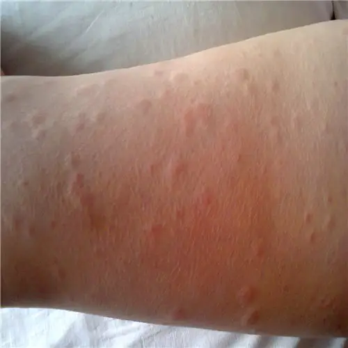 荨麻疹图片_荨麻疹症状表现图片大全_有来医生