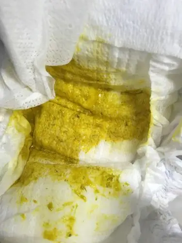 请问消化不良的大便是这样的吗!(有图慎入)只看楼主