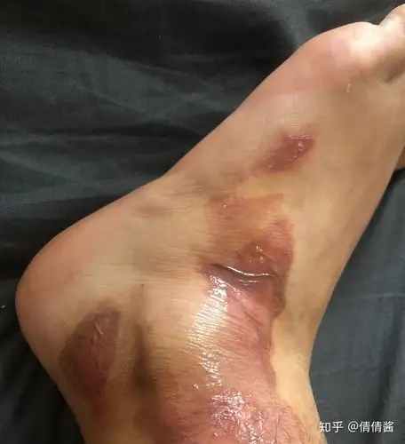 浅二度烫伤的恢复过程