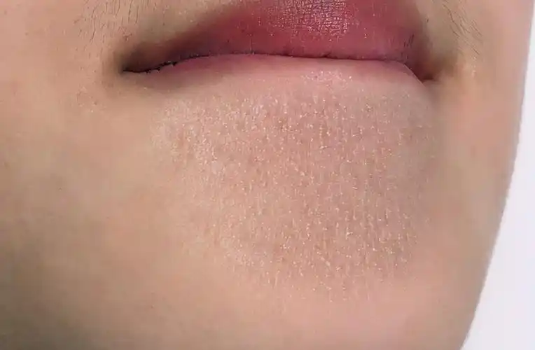 白头粉刺应该怎么去除(下巴出现很多白色粉刺,千万别用手挤,学会这样