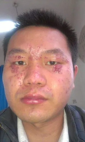 真菌感染皮肤病图 (1)_有来医生