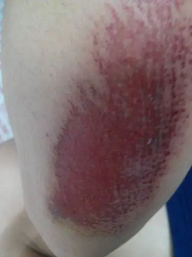 摔得,胳膊用水洗了一下,然后用碘伏擦了