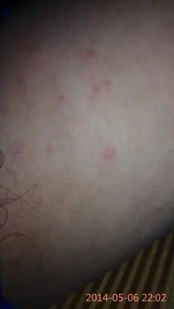 大腿跟部内侧红疹一周,温度高时好痒,用米康唑外用效果差,这是股癣?