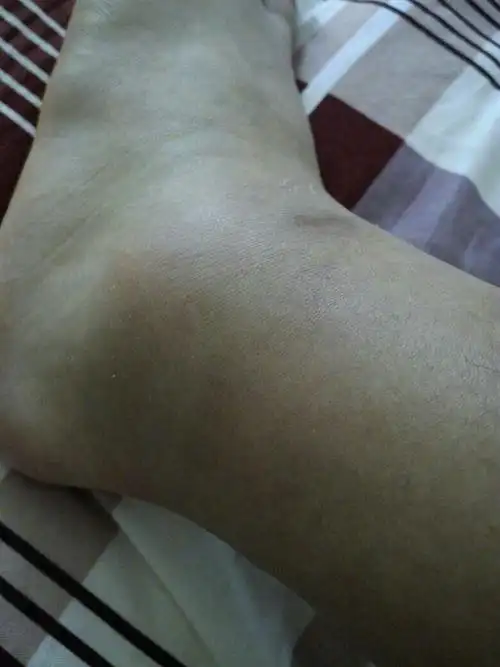 昨天打篮球脚崴了,肿起来了,当时不是很痛 睡了一觉就感觉到了痛.