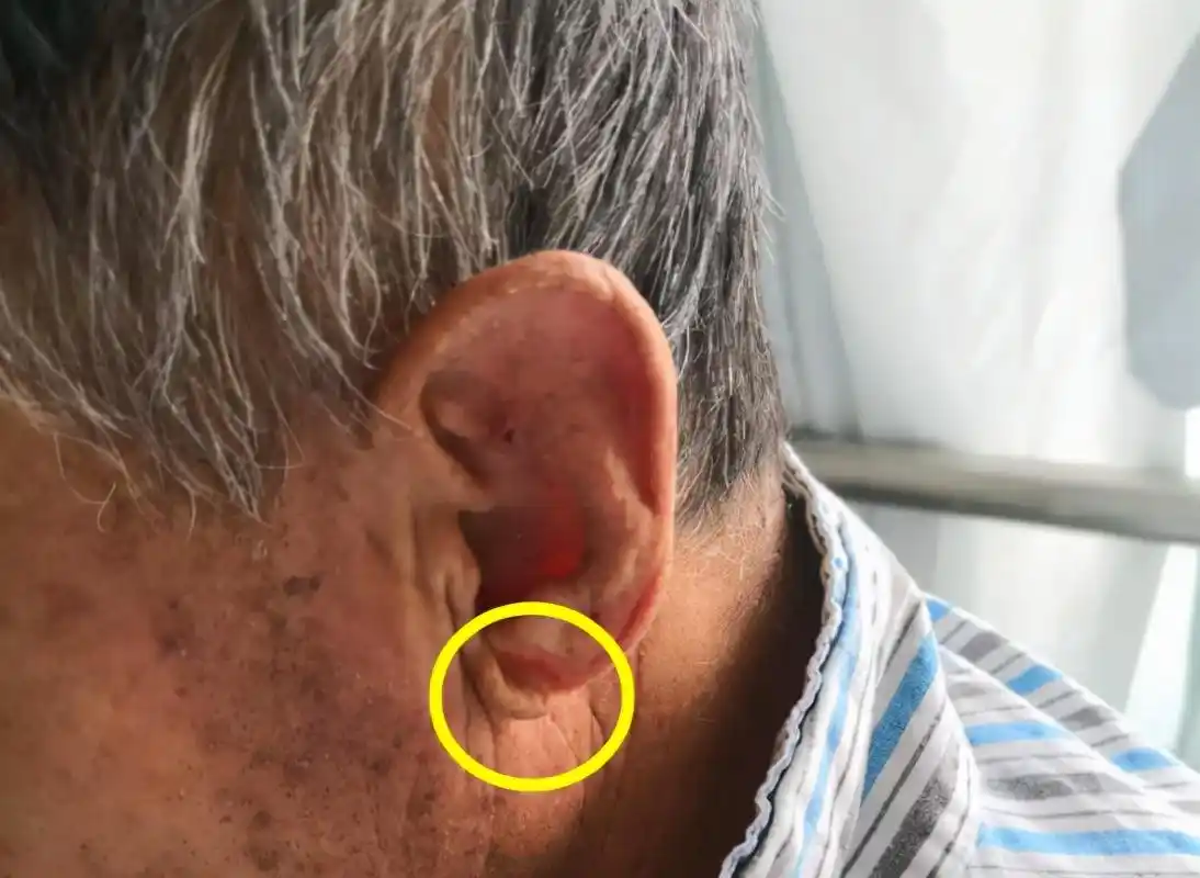 正常人耳垂是光滑的,如果人的一侧或双侧耳朵下面的耳垂出现"折痕",这