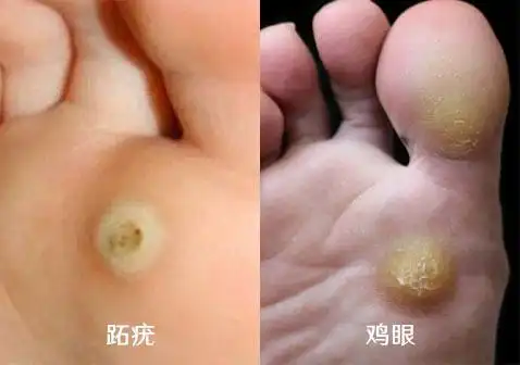 鸡眼和跖疣的区别图对比,有什么区别?听听医生怎么说 第1张
