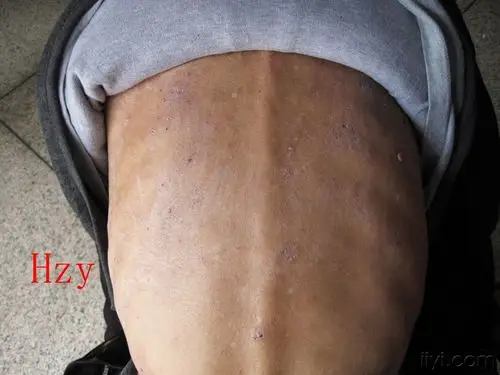 全身皮肤瘙痒十多年