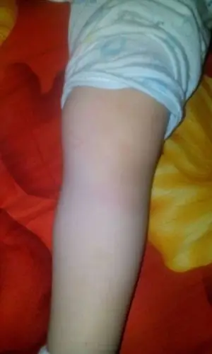 二岁宝宝走路摔跤,快十几天了,能走路,也不说疼,就是膝盖骨下方有突起