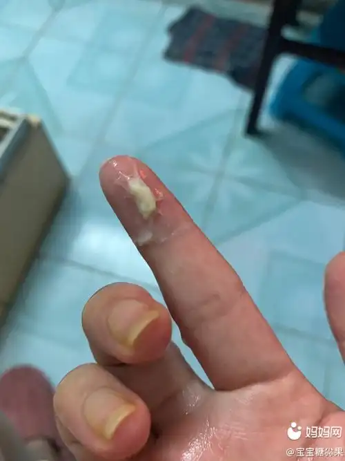 整个孕期阴道炎伴随着我,这个白带像豆腐渣一样还不知_妈妈网孕育社区