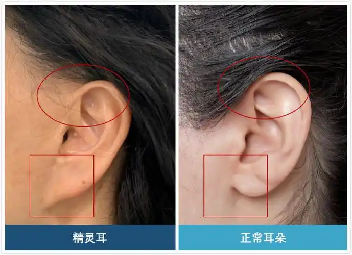 拉皮后耳朵变畸形(风险),医生说出实情!